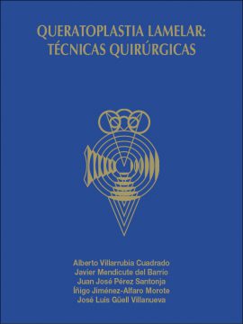 Queratoplastia lamelar: técnicas quirúrgicas