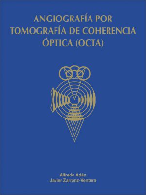 Angiografía por tomografía de coherencia óptica (OCTA)