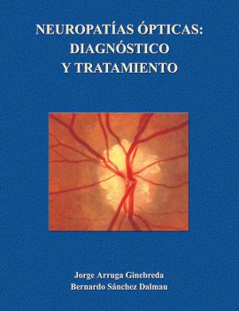 Neuropatías ópticas: diagnóstico y tratamiento