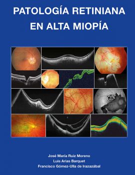 Patología retiniana en alta miopía