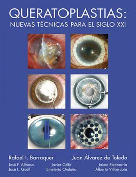 Queratoplastias: nuevas técnicas para el siglo XXI