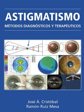 Astigmatismo. Métodos diagnósticos y terapéuticos