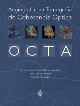 Angiografía por Tomografía de Coherencia Óptica (OCTA)